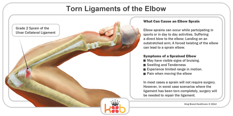 Torn Elbow Ligaments Diagram Information Elbow Sprain Treatment King Brand