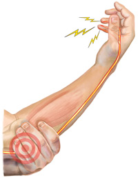 An Illustration of the Areas of Pain in the Elbow that the BFST® Can Treat