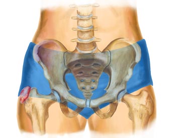 X-Ray View of a Trochanteric Bursitis Injury