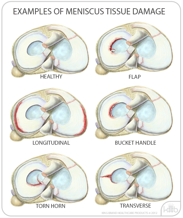 Top View of Meniscus Examples and Types of Meniscus Tissue Damage Knee Injury Solutions King Brand