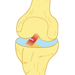 Illustration of a Torn ACL in the Knee