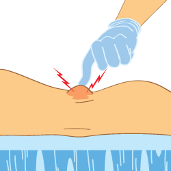 An Illustration of a Doctor Checking a Bakers Cyst Injury