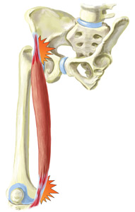 An Illustration of a Sartorius Muscle Injury
